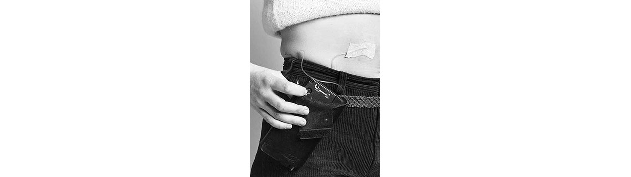Patient with an insulin pump.