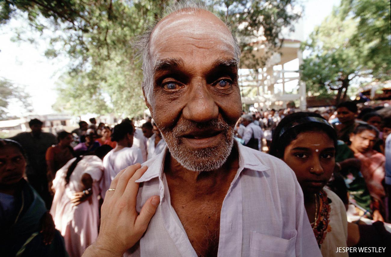 Man with cataracts in Aravind screening camp, India