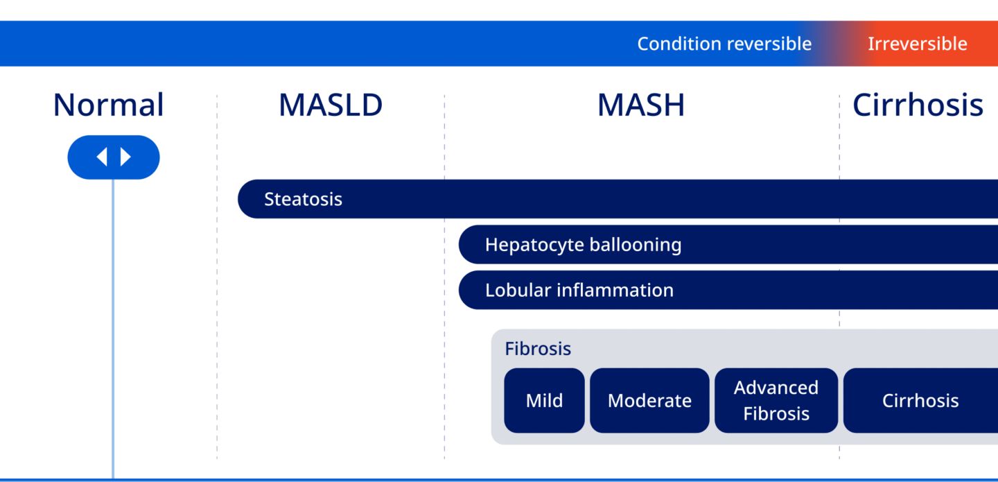 Screen for MASH to prevent serious health risks