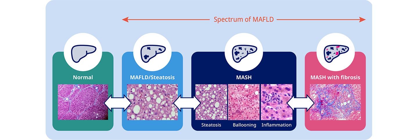 Understanding MASH