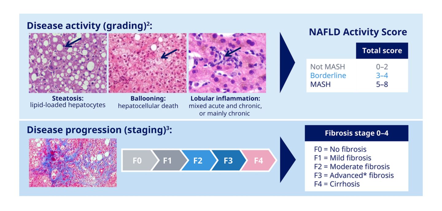 Diagnosis and management of MASH