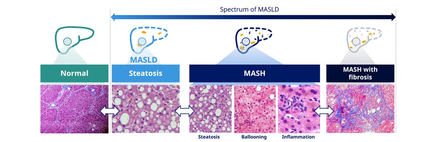 MASH