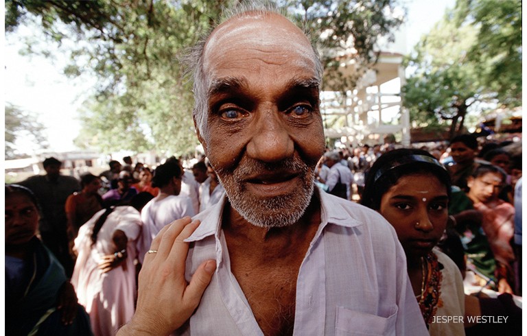 アラビンドのスクリーニングキャンプで出会った白内障の男性（インド）