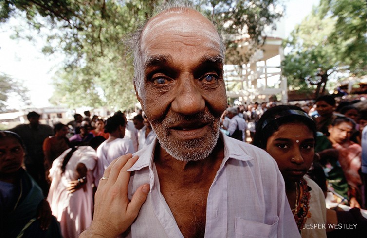 アラビンドのスクリーニングキャンプで出会った白内障の男性（インド）