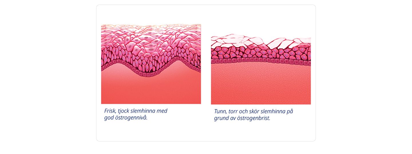 strogenbrist