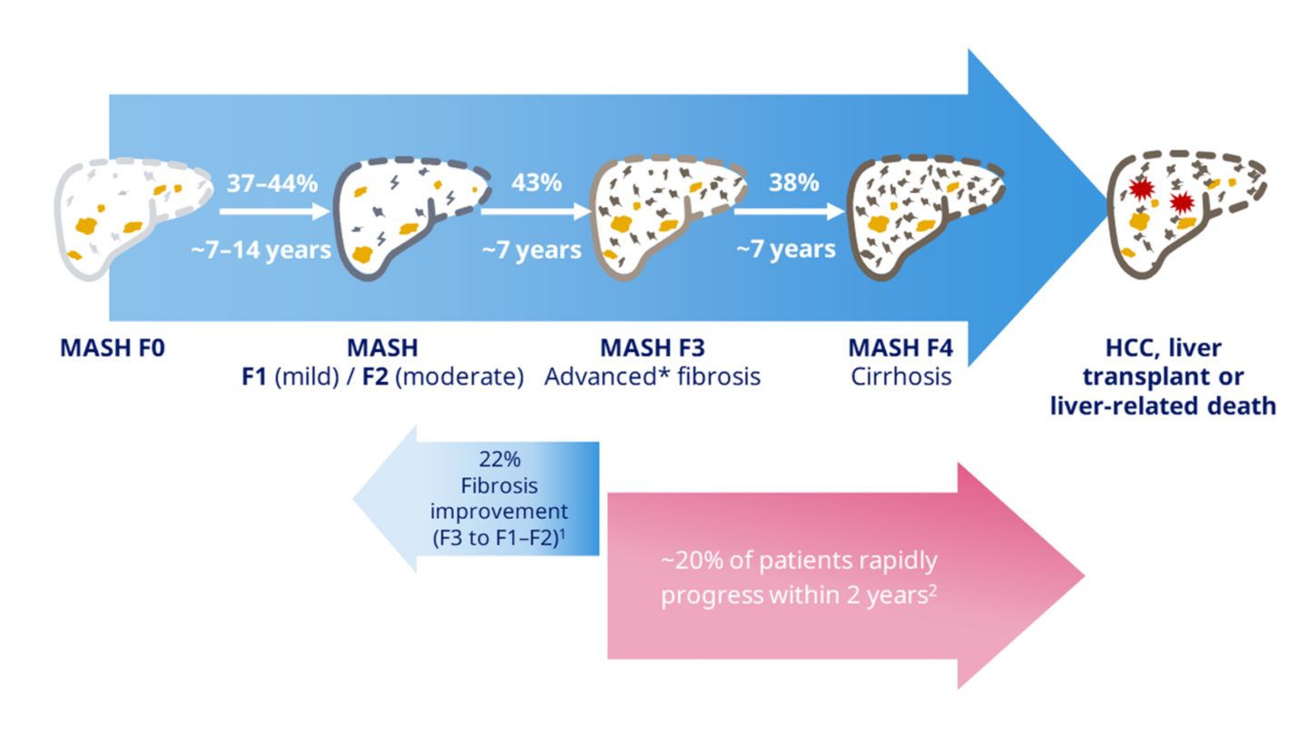 Understanding MASH as a metabolic disease