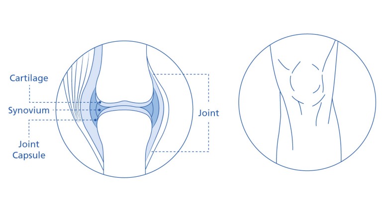 What causes a joint bleed?
